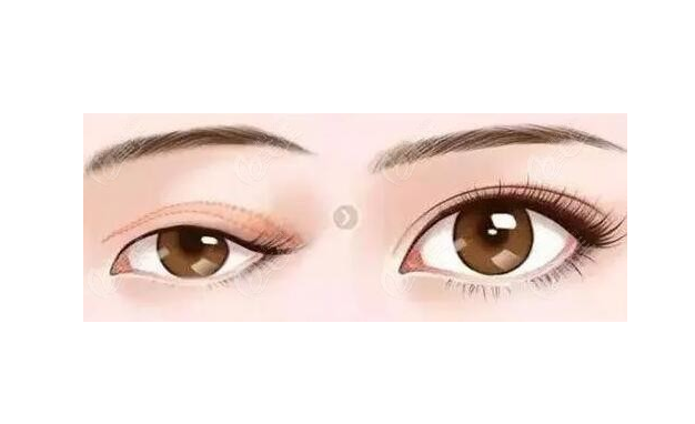 徐州二院哪個醫(yī)生做雙眼皮好？陶常波、張愛君等實力過硬