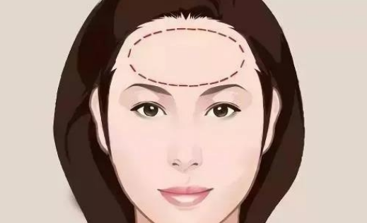 喬雅登雅致適合做哪些部位？皺紋拜拜|玻尿酸去抬頭紋案例附上