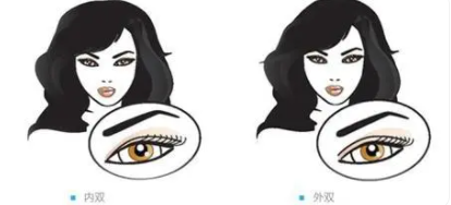 雙眼皮3.png 雙眼皮3.png