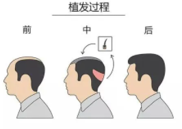 植發(fā)2.png 植發(fā)2.png